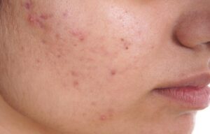 Skin issues: fighting blemishes