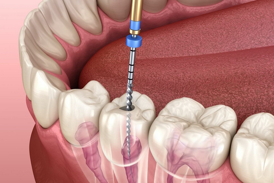Understanding Single-Sitting Root Canal Treatment: Advancements in Dental Care