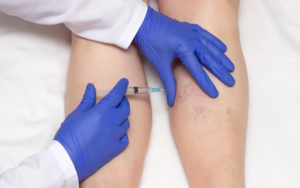 Treatments for Bulging Veins