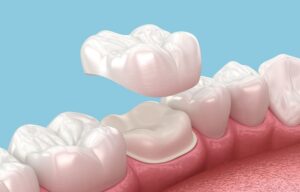 dental crowns.